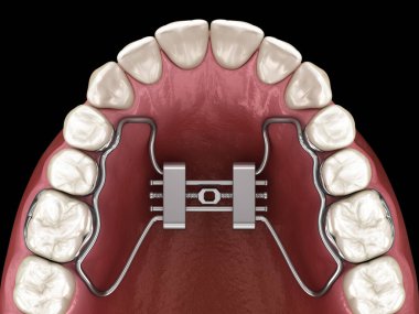 Hızlı Palatal Genişleme. Tıbbi olarak doğru diş 3D illüstrasyon