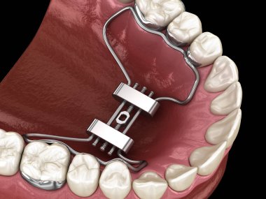 Hızlı Palatal Genişleme. Tıbbi olarak doğru diş 3D illüstrasyon