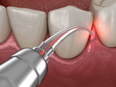 Lazerle sakız düzeltme ameliyatı. Tıbbi olarak doğru diş 3D illüstrasyon