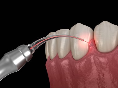 Lazerle sakız düzeltme ameliyatı. Tıbbi olarak doğru diş 3D illüstrasyon