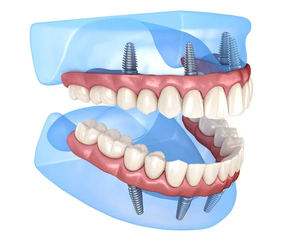 Prótesis Maxilar Mandibular Con Encía Sistema Todo Soportado Por Implantes — Foto de Stock