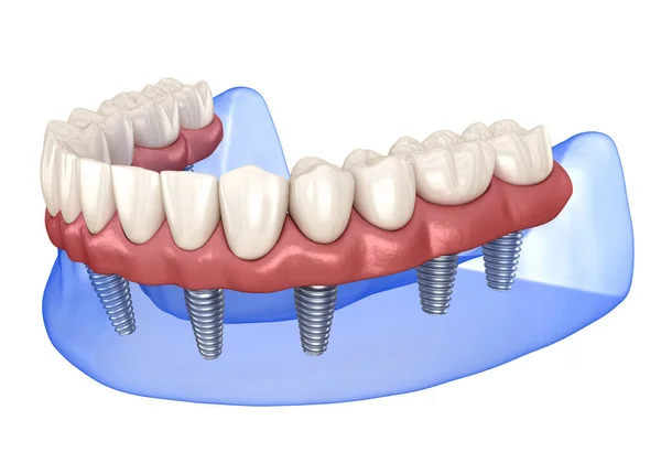 Protesi Maxillare Mandibolare Con Gengiva Tutto Sistema Supportato Impianti Illustrazione — Foto Stock