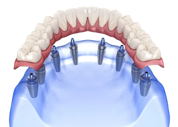 Prótesis Maxilar Mandibular Con Encía Sistema All Soportado Por Implantes — Foto de Stock