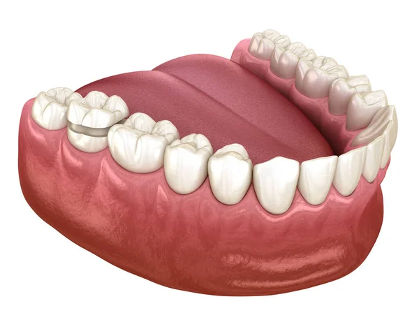 臼歯の上にセラミッククラウン固定のみ 人間の歯の治療の医学的に正確な3Dイラスト — ストック写真
