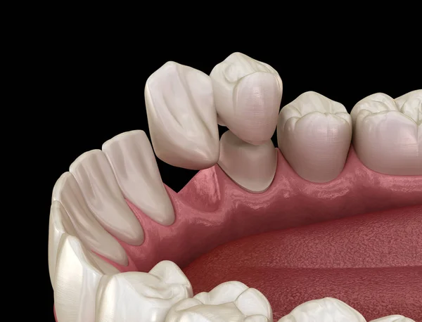 Ponte Cantilever Feita Cerâmica Recuperação Dentes Frontal Animação Medicamente Precisa — Fotografia de Stock