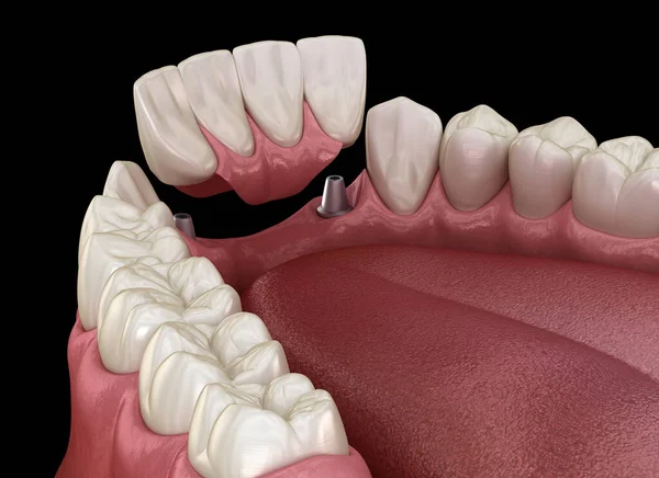 前牙桥由植入物支撑 医疗上准确的牙科概念3D动画 — 图库照片