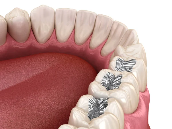 アマルガムの修復だ 歯科概念の医学的に正確な3Dアニメーション — ストック写真