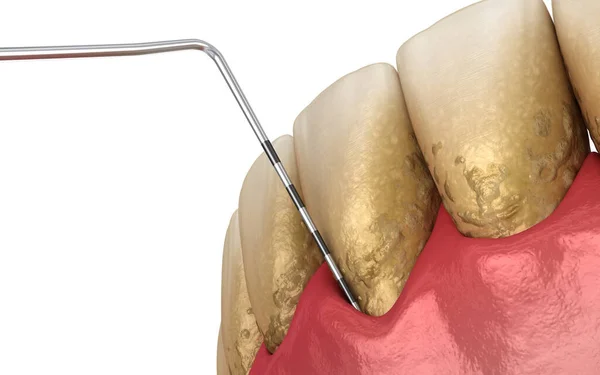 Badanie Periodontitis Proces Recesji Dziąseł Medycznie Dokładna Ilustracja — Zdjęcie stockowe