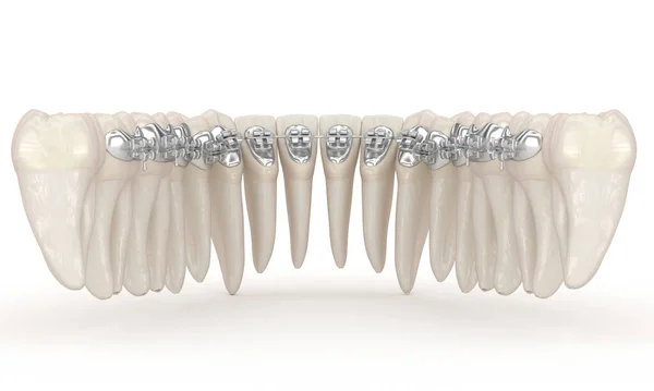 Lingual Aparat Ortodontyczny Koncepcja Ilustracji Srebrnych Aparatów — Zdjęcie stockowe