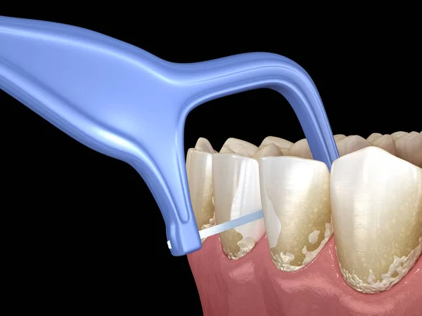 口腔衛生 歯から立ち往生食品を削除するためにつまようじデンタルフロスを使用しています 医学的に正確な歯科3Dイラスト — ストック写真