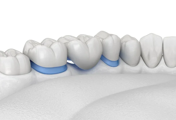 Porcellana Ponte Dentale Denti Molare Premolare Illustrazione Clinicamente Accurata Del — Foto Stock