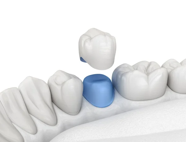 Porslin Krona Placering Över Premolar Tand Medicinskt Korrekt Illustration — Stockfoto