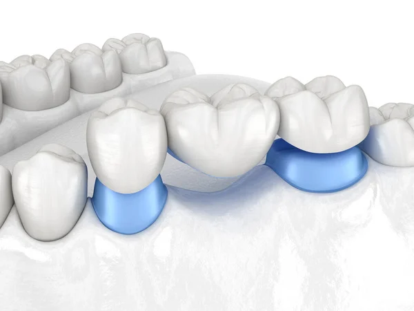磁器臼歯と前臼歯の上に3歯の歯科ブリッジ 人間の歯の治療の医学的に正確な3Dイラスト — ストック写真