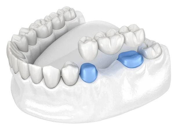 Porcelana Puente Dental Dientes Sobre Molar Premolar Ilustración Médicamente Precisa —  Fotos de Stock