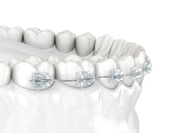 Denti Bretelle Chiare Illustrazione Dentale Clinicamente Accurata — Foto Stock