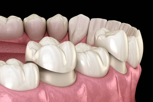 前歯と臼歯の上に磁器の冠の配置 そうだ 医学的に正確な3Dイラスト — ストック写真