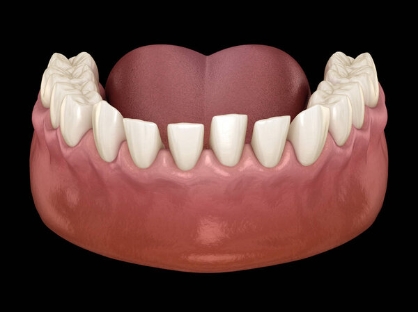 Excessive Spacing between teeth. Dental 3D illustration concept