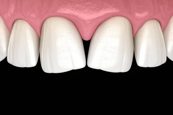 中央の切開部の歯の収束性ジアステマ 歯科機能不全3Dイラストコンセプト — ストック写真