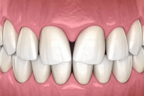 Zbieżna Diastema Środkowych Siekaczy Zębów Zaburzenia Stomatologiczne Koncepcja Ilustracji — Zdjęcie stockowe