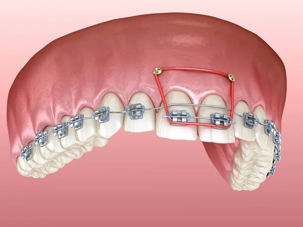 Elastici Bretelle Metalliche Correzione Overbite Incisivi Frontali Illustrazione Dentale Clinicamente — Foto Stock
