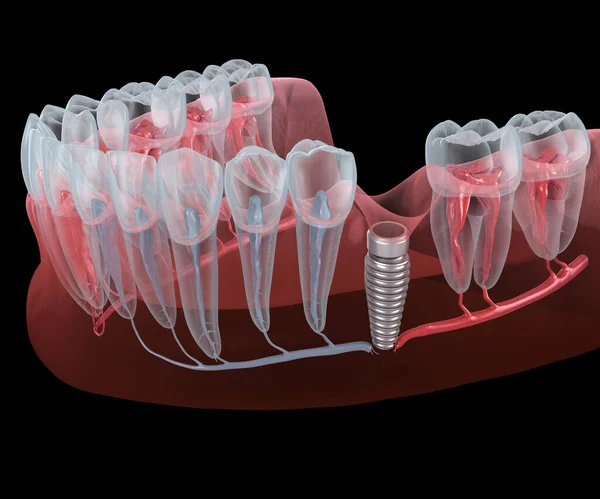 Resultado Implantação Dentária Mal Sucedida Quebra Nervo Ilustração Odontológica Medicamente — Fotografia de Stock