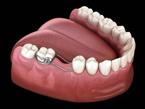 Space Maintainer Unilateral keeps from teeth shift deformatiuon after losing molar tooth. 3D illustration