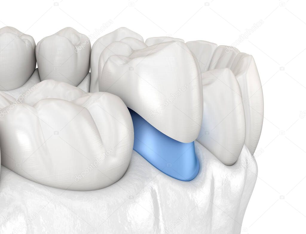 Porcelain crown placement over premolar tooth. Medically accurate 3D illustration