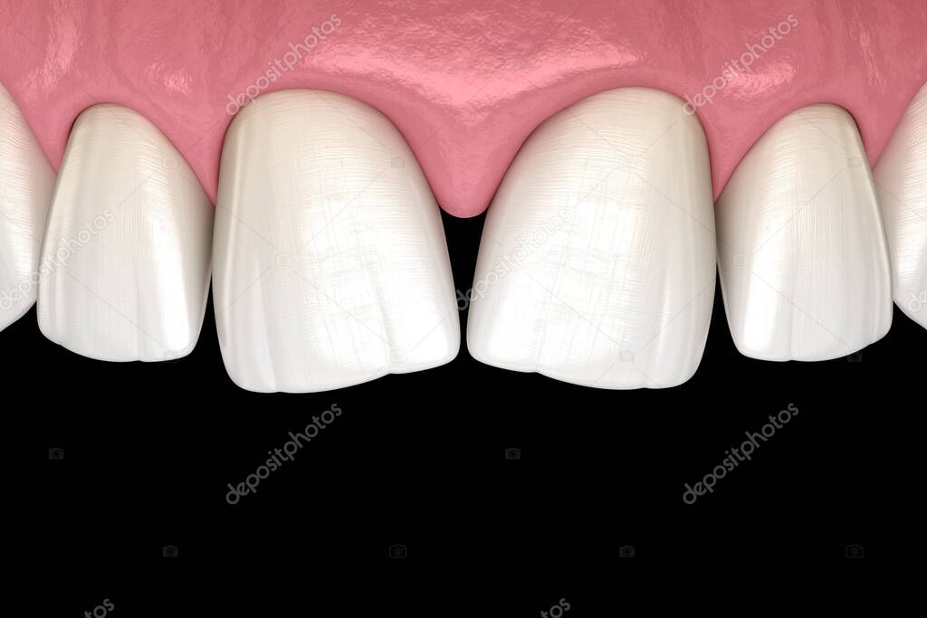 Convergent diastema of central incisors teeth. Dental disfunction 3D illustration concept