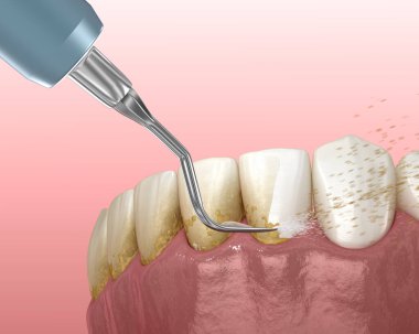 Ağız temizliği: Ölçekleme ve kök planlama (geleneksel periodontal terapi). İnsan diş tedavisinin tıbbi açıdan doğru üç boyutlu çizimi