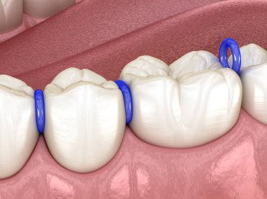 Dişlerin arasındaki lastik ayırıcı, diş tellerinin yerleştirilmesi için hazırlık. Tıbbi olarak doğru olan 3 boyutlu diş illüstrasyonu