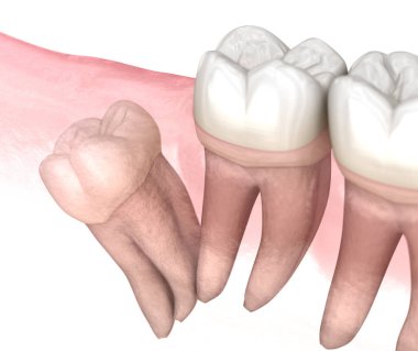Bilgelik dişinin uzak etkisi. Tıbbi olarak doğru diş 3D illüstrasyon