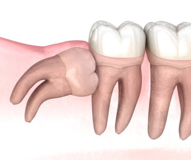 Bilgelik dişinin yatay etkisi. Tıbbi olarak doğru diş 3D illüstrasyon
