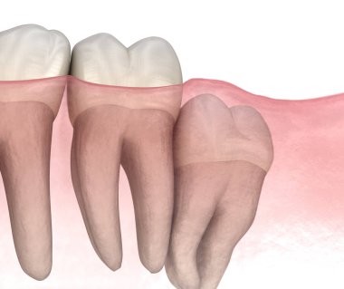 Bilgelik dişinin dikey etkisi. Tıbbi olarak doğru diş 3D illüstrasyon