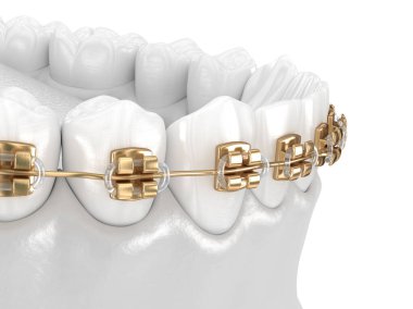 Healthy Teeth with gold braces, white teeth concept, dental 3D illustration clipart