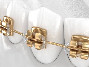 Altın diş telli sağlıklı dişler, beyaz diş konsepti, 3 boyutlu diş çizimi