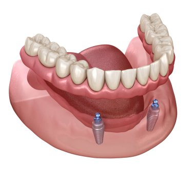 Mandibular removable prosthesis All on 2 system supported by implants with ball attachments. Medically accurate dental 3D illustration clipart