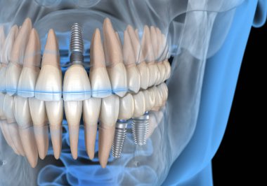 Diş köprüsü implantlarla destekleniyor. İnsan dişleri ve protez kavramının tıbben doğru üç boyutlu çizimi