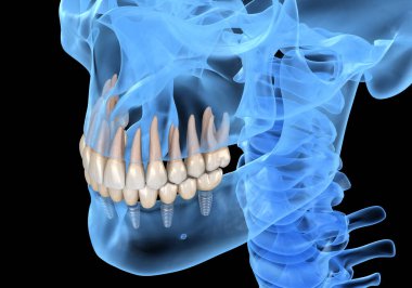 Çene protezi. Hepsi de implantlarla desteklenen 6 sistemde. İnsan dişleri ve protez kavramının tıbben doğru üç boyutlu çizimi