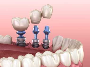 3 implantın üzerine 3 diş yerleştirme - kavram. İnsan dişlerinin ve takma dişlerinin 3 boyutlu çizimi
