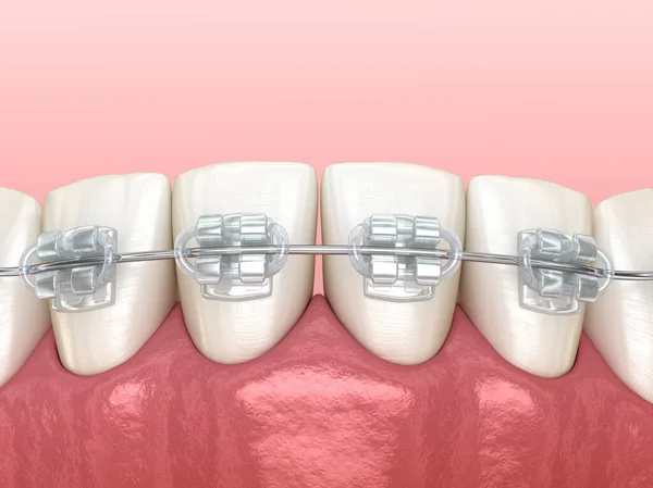 Mascella Mandibolare Bretelle Trasparenti Illustrazione Dentale Clinicamente Accurata — Foto Stock
