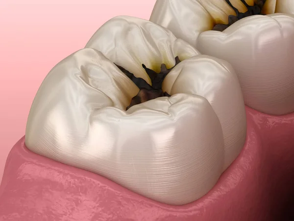 ケアによって損傷を受けた臼歯 医学的に正確な歯3Dイラスト — ストック写真