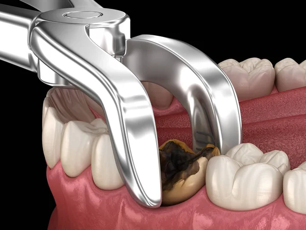 Extracción Del Diente Molar Dañado Por Caries Ilustración Dientes Médicamente —  Fotos de Stock