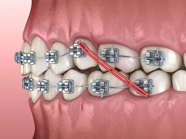 Еластичні Металеві Брекети Корекції Укусу Зубів Медично Точна Стоматологічна Ілюстрація — стокове фото