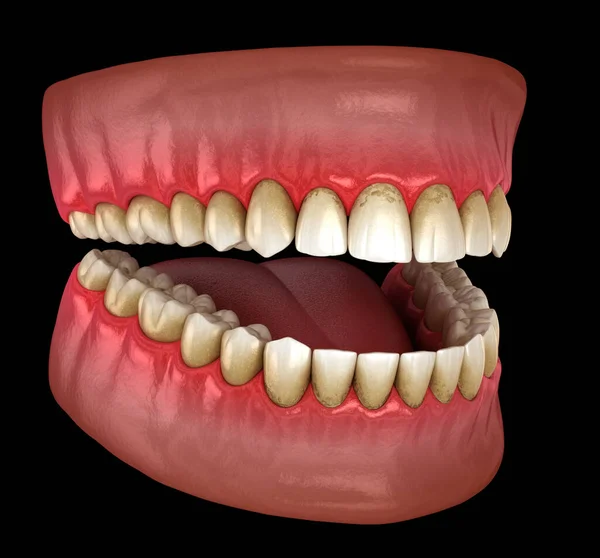 Tartar Bactrail Tooth Plaque Jaw Inflammation Medically Accurate Illustration Human — Stock Photo, Image