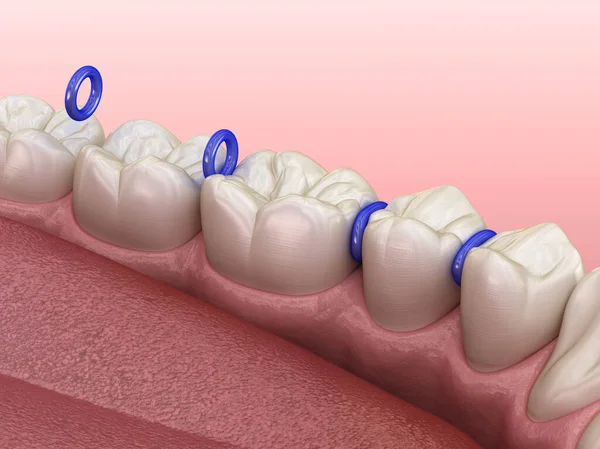 Separator Gumy Między Zębami Przygotowanie Umieszczenia Aparatu Zęby Medycznie Dokładna — Zdjęcie stockowe