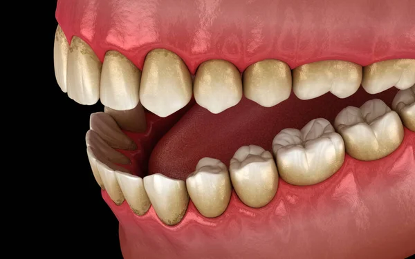 Zahnstein Und Zahnbelag Kieferentzündung Medizinisch Genaue Abbildung Der Behandlung Menschlicher — Stockfoto