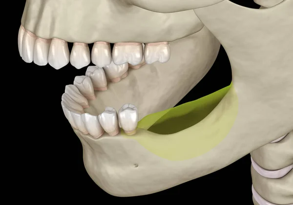 Mandibular Jaw Bone Recession Losing Molars Teeth Medically Accurate Dental — Stock Photo, Image