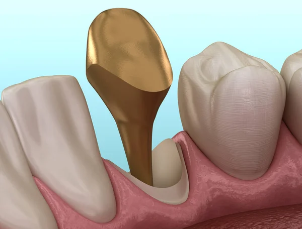 Gouden Stomp Pin Tab Canaine Tand Medisch Nauwkeurige Tandheelkundige Illustratie — Stockfoto