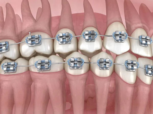 Metallstag Och Transparent Dentalmodell Medicinskt Korrekt Illustration — Stockfoto