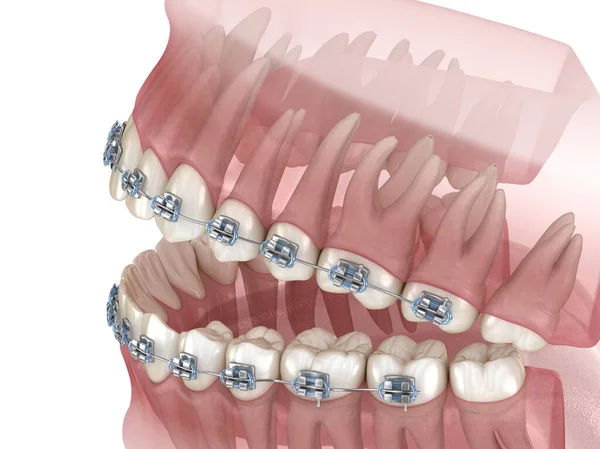 Bretelle Metalliche Modello Dentale Trasparente Illustrazione Clinicamente Accurata — Foto Stock